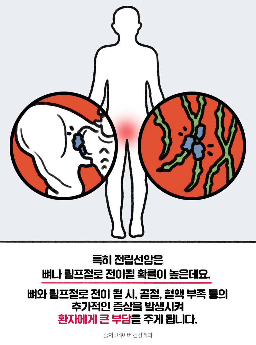 전립선 암-5