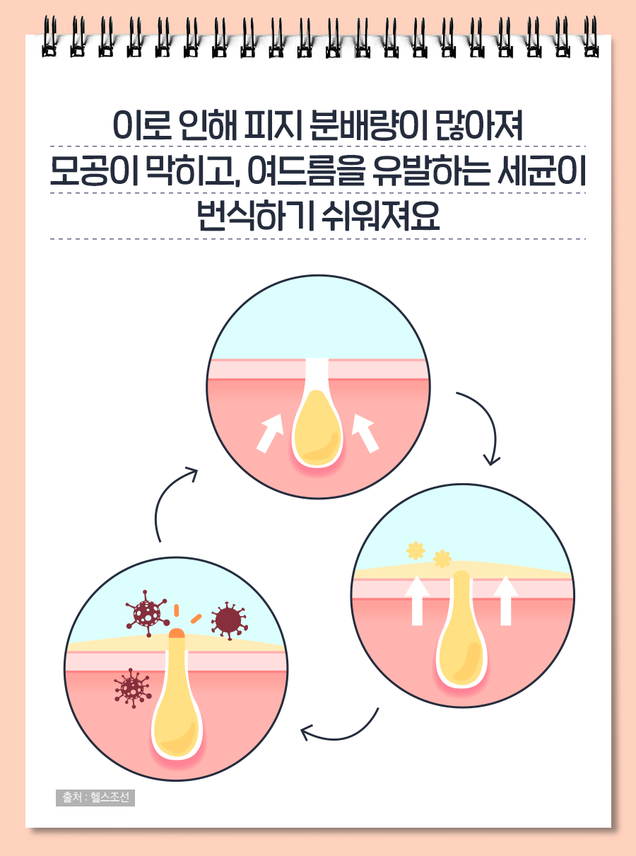 이로 인해 피지 분비량이 많아져 모공이 막히고, 여드름을 유발하는 세균이 번식하기 쉬워져요