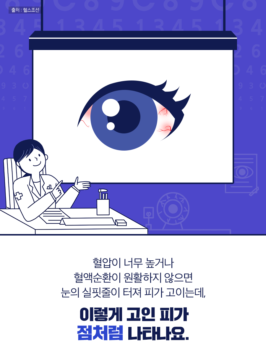 혈압이 높거나 혈액순환이 원활하지 않으면 눈의 실핏줄이 터져 피가 고이는데, 이렇게 고인 피가 점처럼 나타나요.