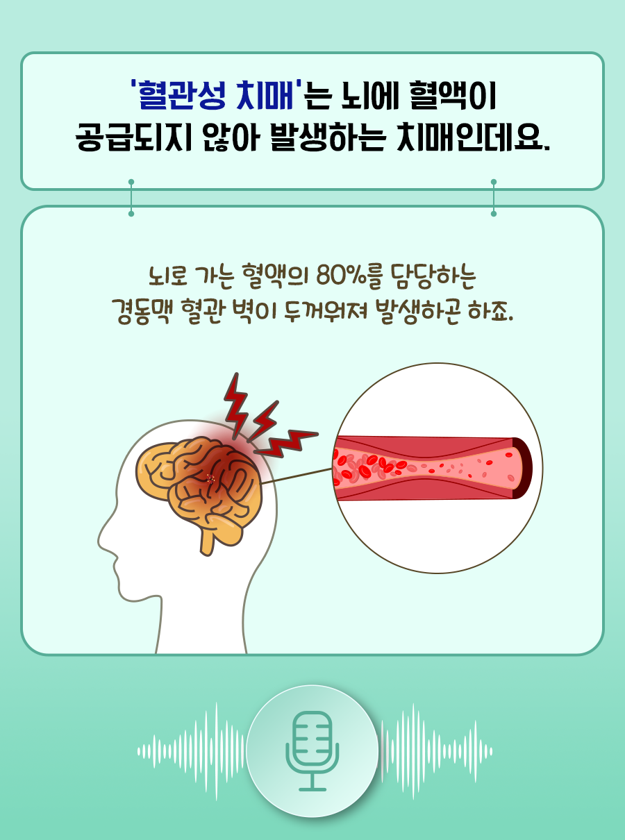 혈관성 치매는 뇌에 혈액이 공급되지 않아 발생하는 치매인데요. 뇌로 가는 혈액의 80%를 담당하는 경동맥 혈관 벽이 두꺼워져 발생하곤 하죠.