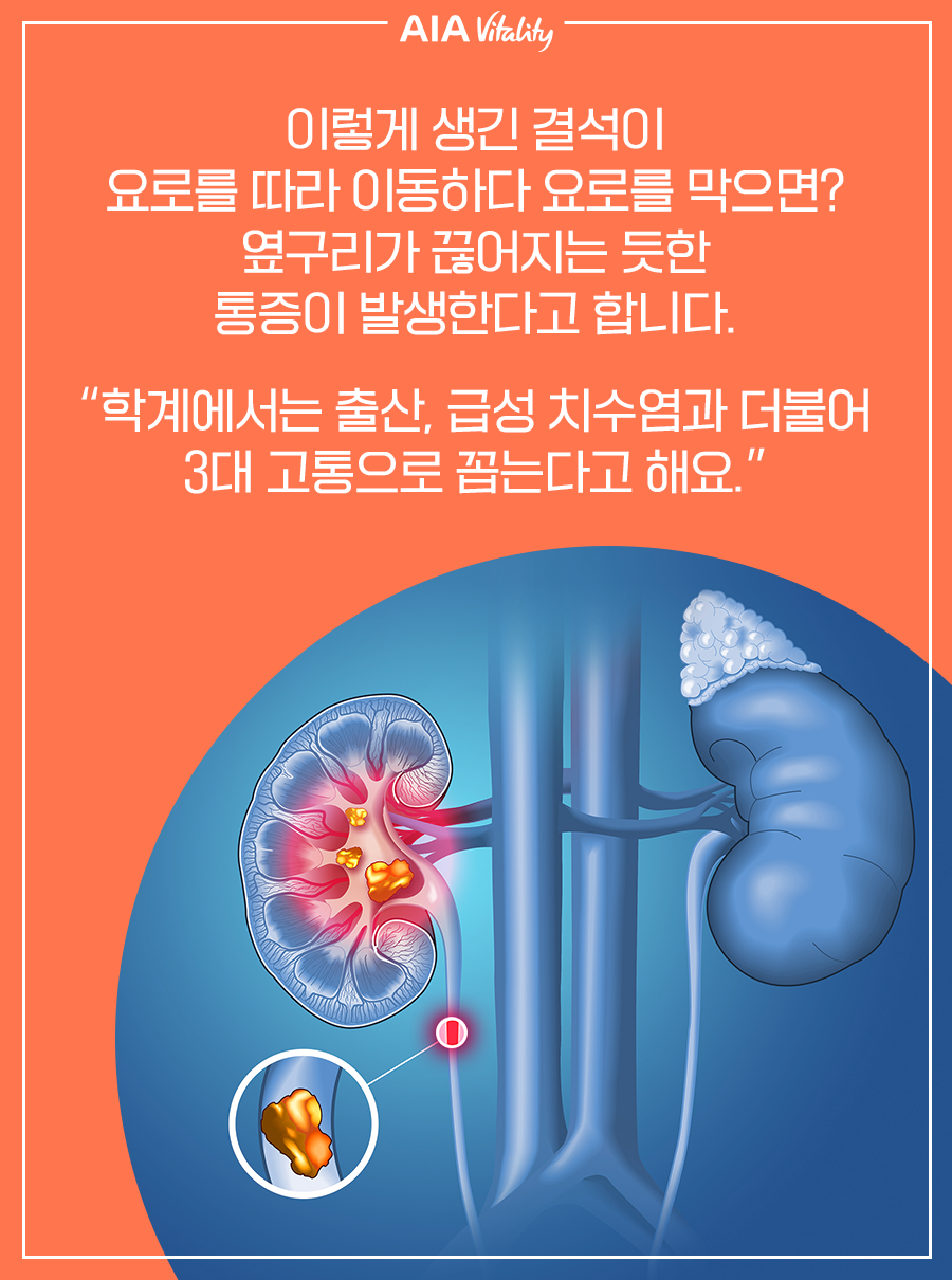 이렇게 생긴 결석이 요로를 따라 이동하다 요로를 막으면? 옆구리가 끊어지는 듯한 통증이 발생한다고 합니다. 학계에서는 출산, 급성 치수염과 더불어 3대 고통으로 꼽는다고 해요.